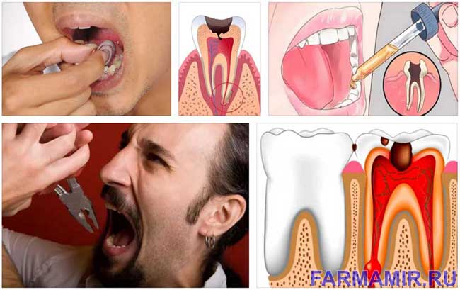  Сильно болит зуб, что делать?  Полезные народные советы 