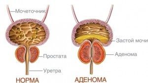 prostatadenoma