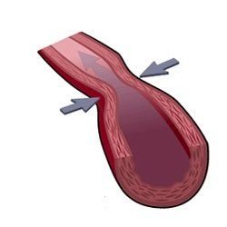 Спазм коронарных артерий еще больше усугубляет нарушения кровотока