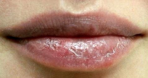 сухие губы