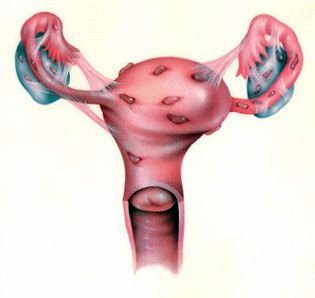 симптомы и лечение эндометриоза матки