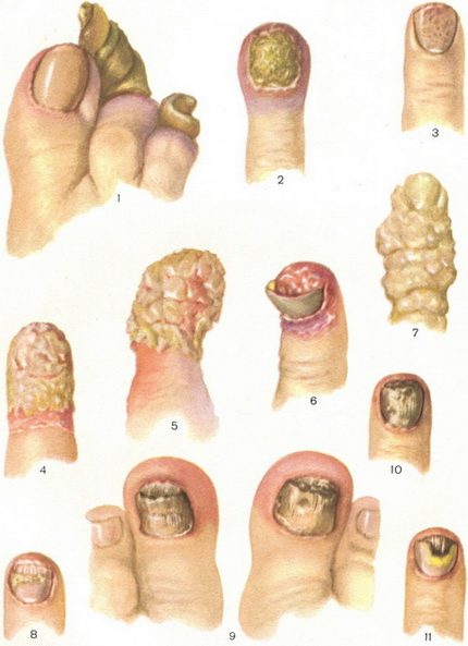 болезни ногтей мифы
