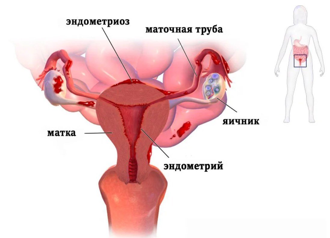 Эндометриоз связан с более высоким риском развития осложнений во время беременности