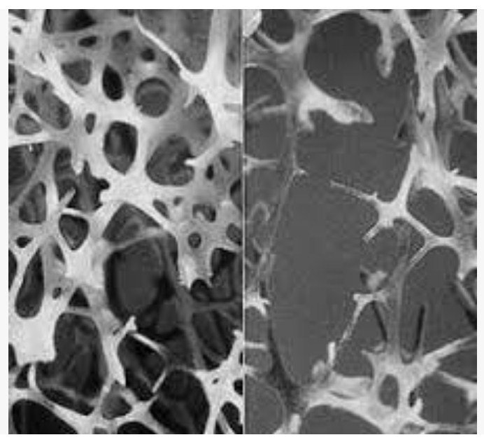 Новая терапия стволовыми клетками противостоит влиянию остеопороза у мышей