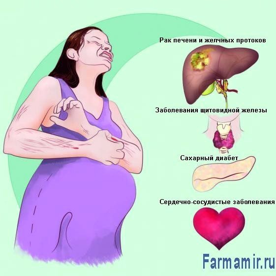 внутрипеченочный холестаз беременности с раком печени