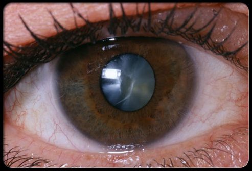что такое катаракта