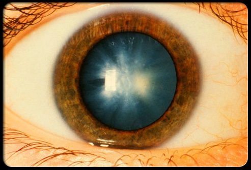 Каковы причины катаракты?