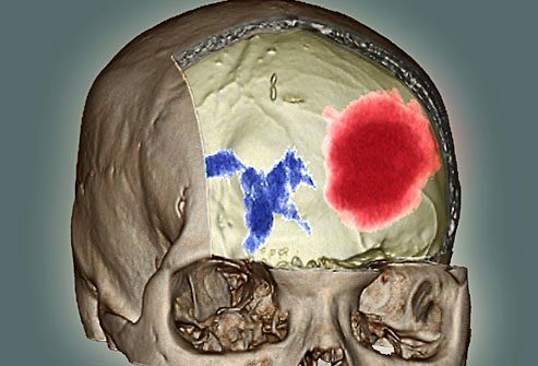 Кровоизлияние в головной мозг