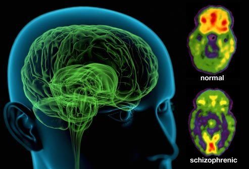 Что такое шизофрения?