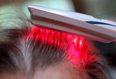 Лечение выпадения волос: Лазерные устройства