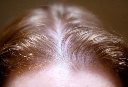 Выпадение волос у женщин: причины и решение проблемы