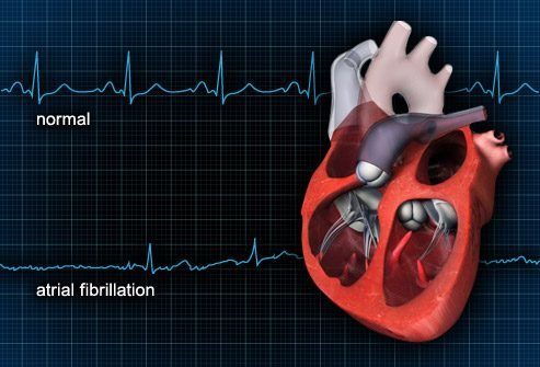 Нерегулярное сердцебиение: Аритмия