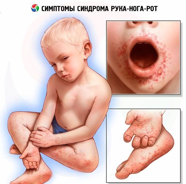 Герпетическая ангина у детей лекарственные препараты thumbnail