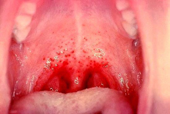 Герпетическая ангина рот ребенка