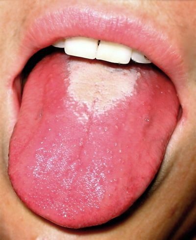 Скарлатина сыпь на языке