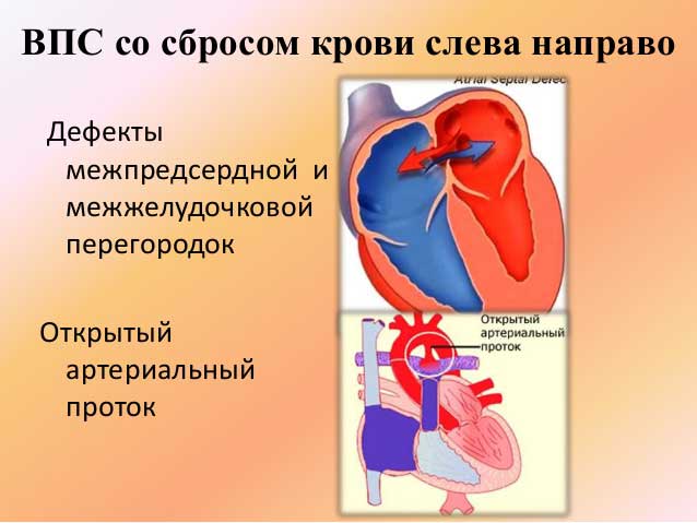 Пороки сердца при сбросе крови слева направо