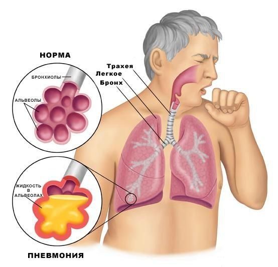  Пневмония - осложнения после гриппа 