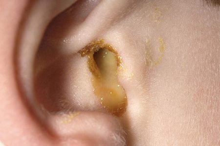 Гнойные очаги ушных раковин и слухового прохода при наружном гнойном отите также подлежат вскрытию