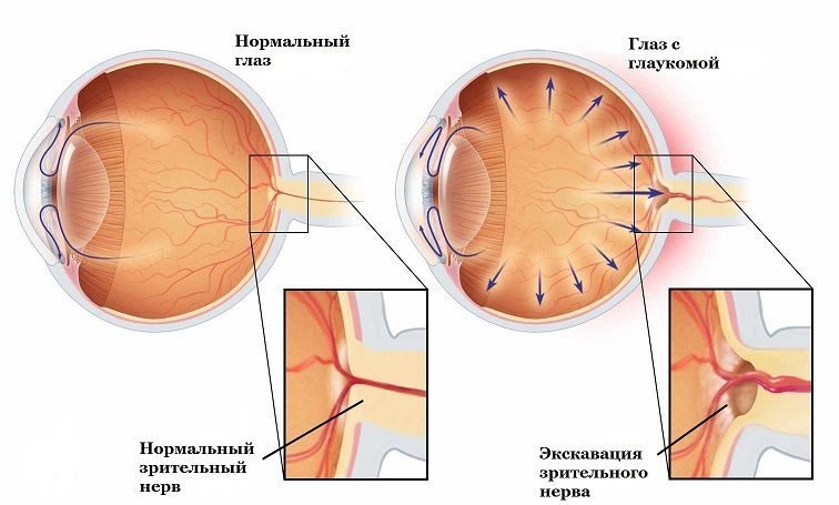 Открытоугольная глаукома - причины, симптомы, диагностика и способы лечение 