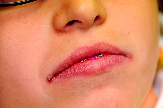 Заеды в уголках рта: причины развития, проявления, способы лечения