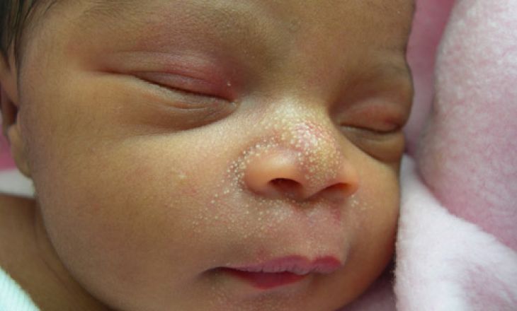 Белые точки на носу у новорожденного