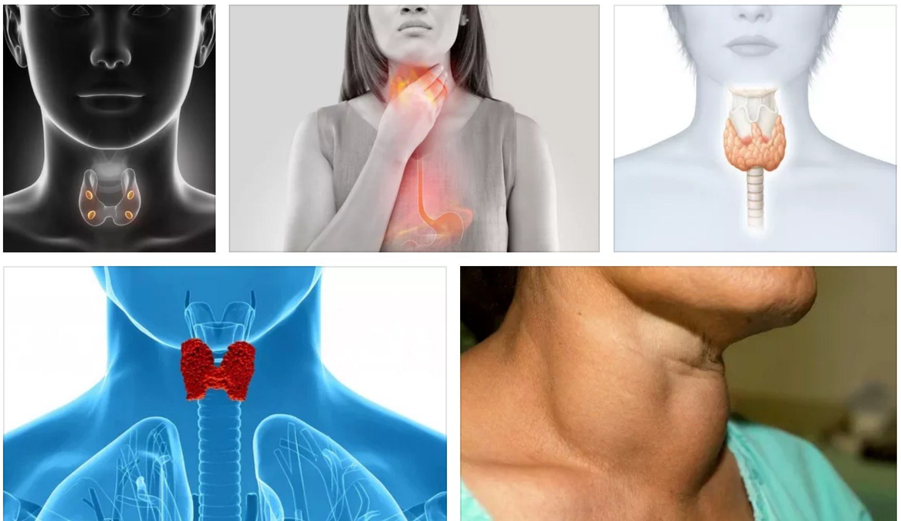 10 симптомов гипофункции щитовидной железы или как проявляет себя гипотиреоз