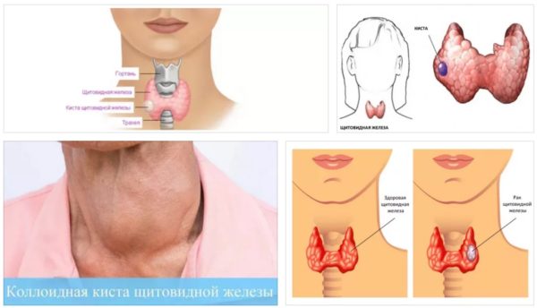 Киста щитовидной железы: обнаружение и методы лечения