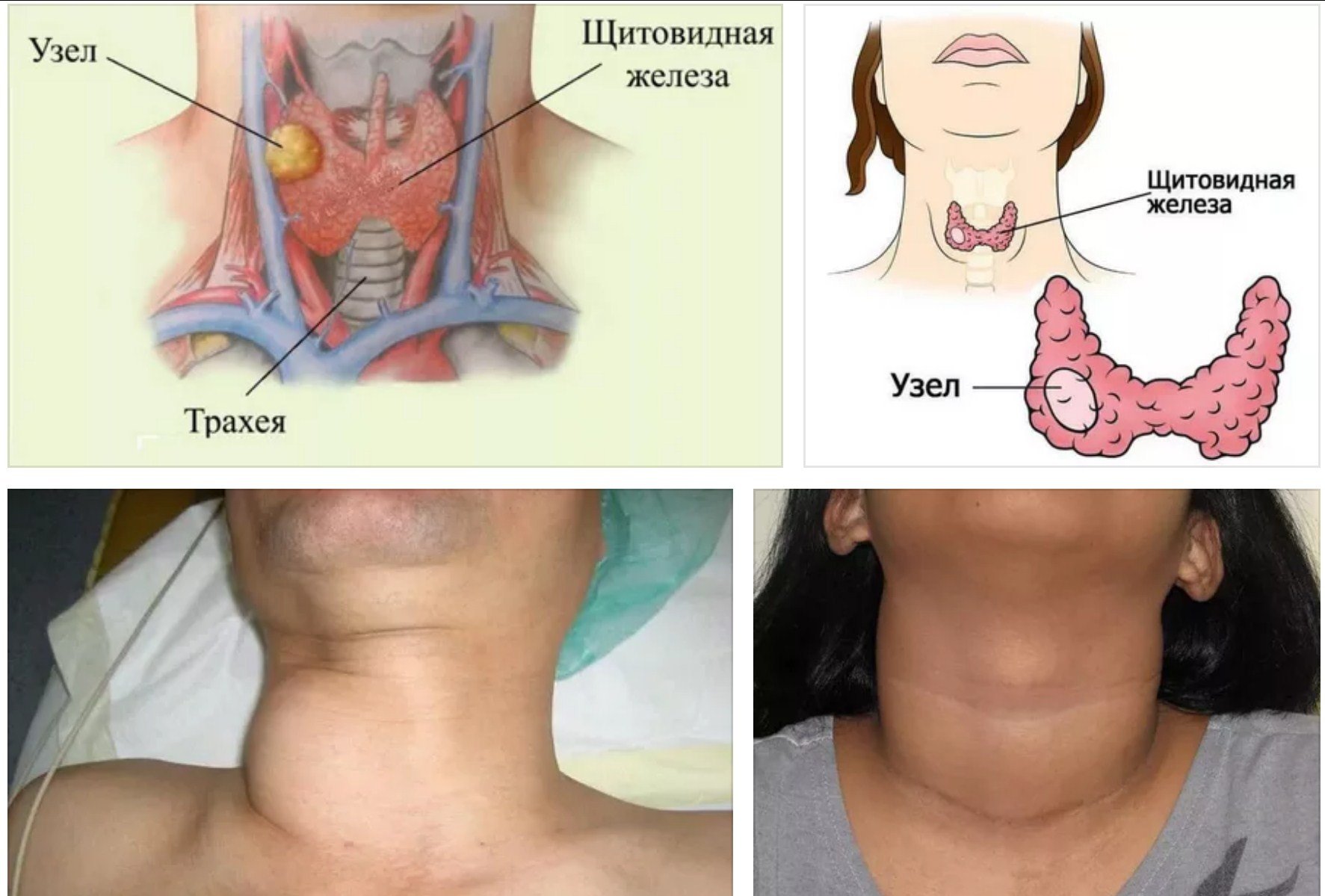 Узлы в щитовидной железе: заболевание и пути его устранения. Общие понятия о состоянии