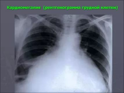 рентгенография грудной клетки 