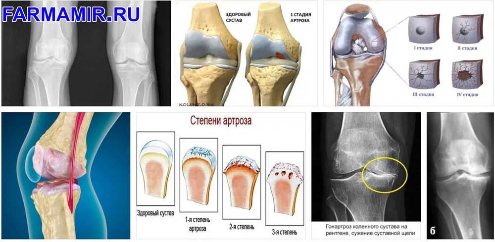 Артроз коленного сустава 1 степени: как вылечить заболевание