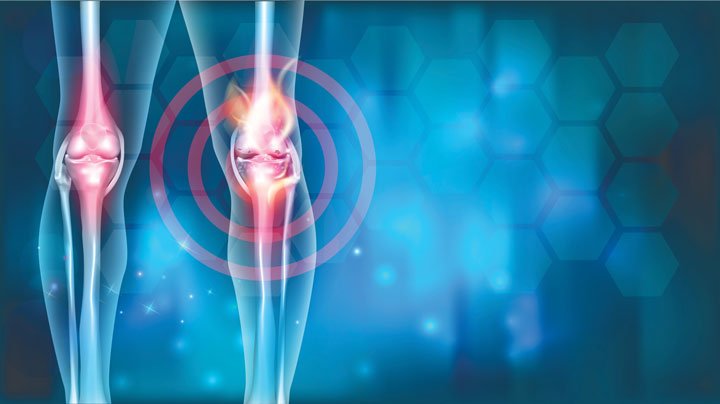 Остеоартроз  коленного сустава 2 степени. Эффективные методы лечения