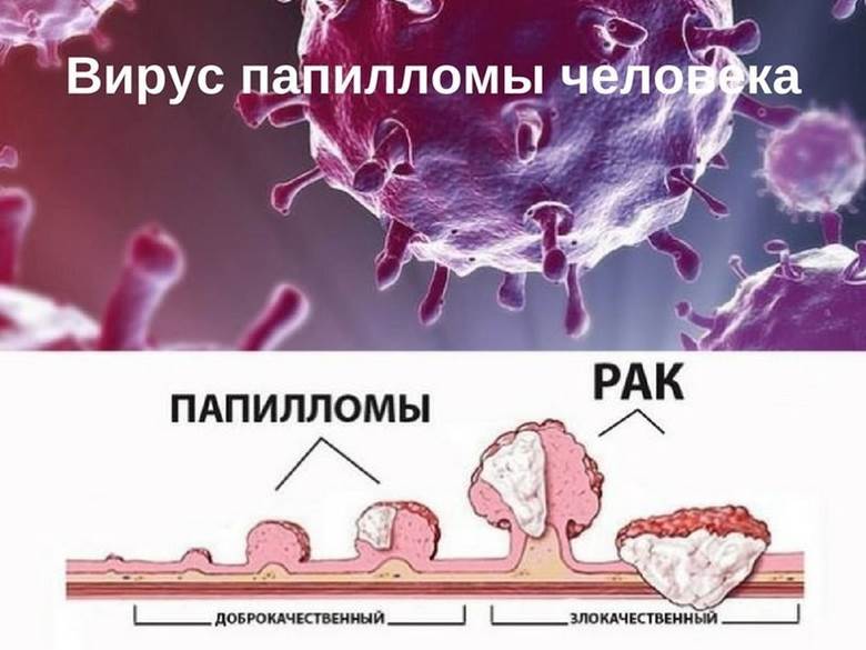 вирус паппиломы и рак виды